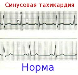Cинусовая аритмия сердца