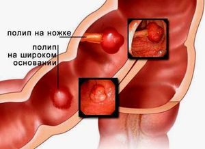 Можно ли пить перед сигмоскопией